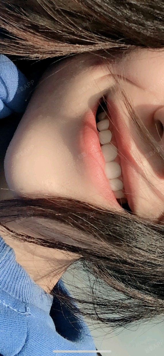 全瓷牙