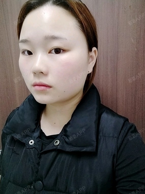 第十天了,效果慢慢明显了,效果还是挺满意的,打瘦脸针一定要选好医生