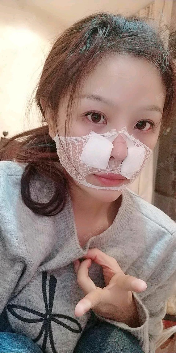 鼻基底好不好_效果图_氧气xzfjy假体垫鼻基底术后第0天_新氧美容整形