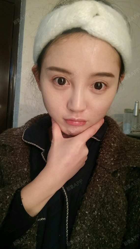 鼻部 | 术后当自强 | 重庆同城 | 自体脂肪填充 | 自体脂肪填充泪 