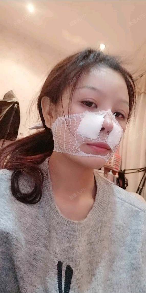 鼻基底好不好_效果图_氧气xzfjy假体垫鼻基底术后第0天_新氧美容整形