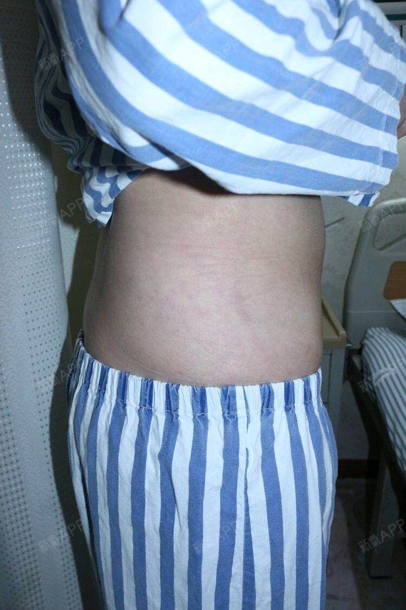 成都吸脂瘦全身好不好_效果图_氧气kbsbb1a吸脂瘦全身术后第0天_新氧