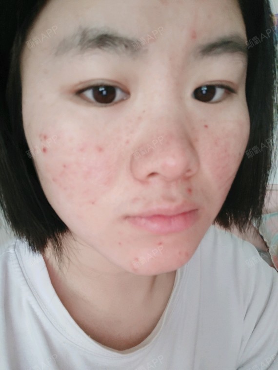 南京果酸焕肤好不好_效果图_氧气x8jof果酸焕肤术后第1天_新氧美容