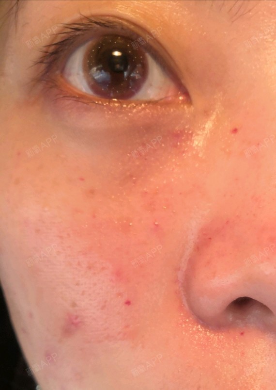 打了这么多次水光,如图一,针孔如此明显,还有淤血的_圈子-新氧美容