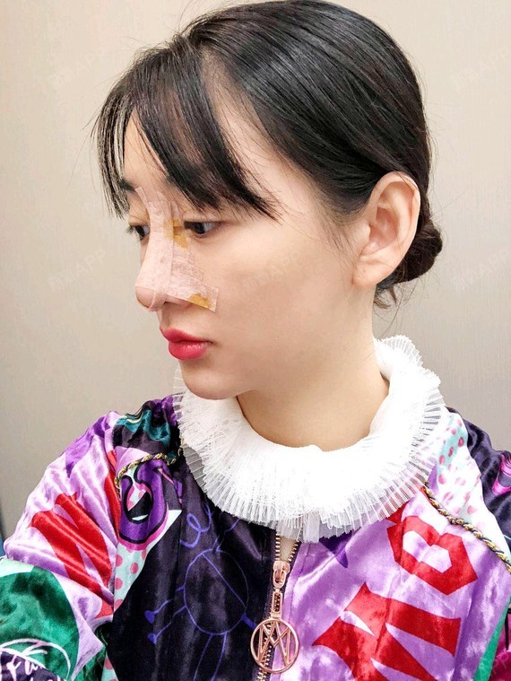 桥豆麻袋袋肋软骨隆鼻第2天美丽日记