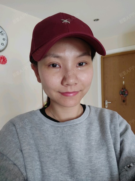 小马虎眼切开双眼皮第7天美丽日记-新氧美容整