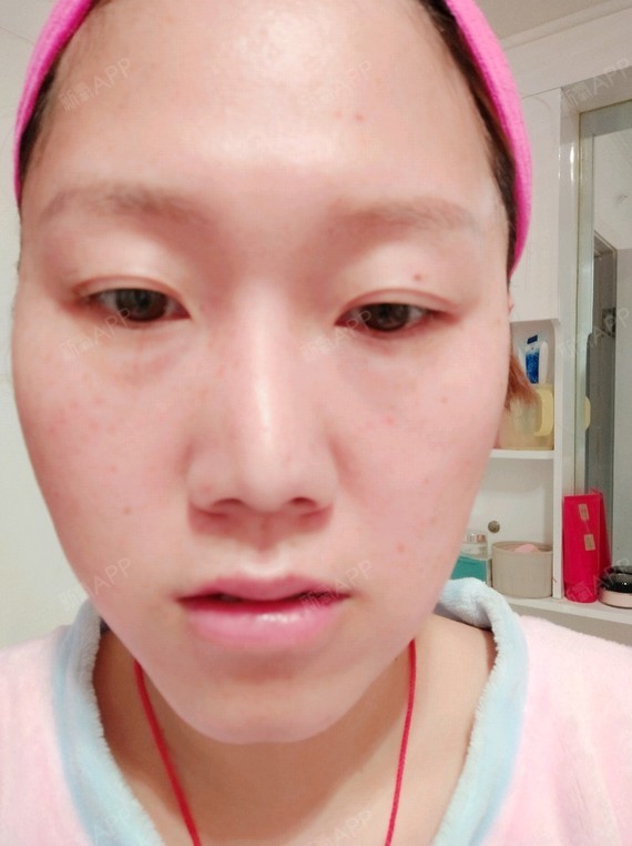 我又来了,今天在这里做了m22王者之冠的祛斑项目,_圈子-新氧美容整形