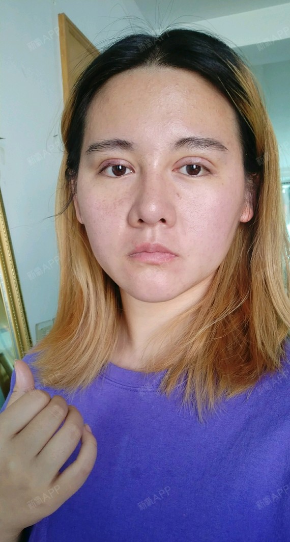 杭州上眼睑去脂好不好_效果图_氧气_kb2b8baf0上眼睑去脂术后第107天