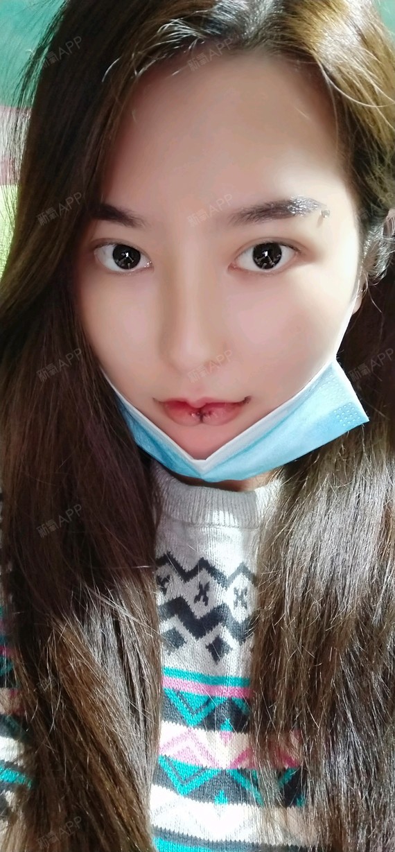 成都m唇手术好不好_效果图_丑小鸭小白苏m唇手术术后第1天_新氧美容
