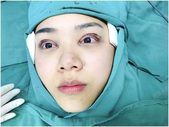 定点双眼皮好不好_效果图_氧气zt347定点双眼皮术后第1天_新氧美容