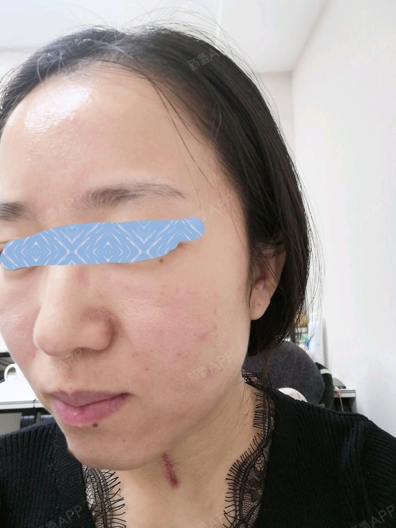 玻尿酸