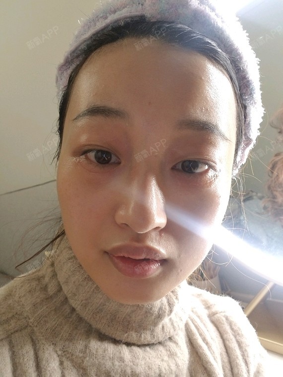 氧气zy177内切去眼袋第29天美丽日记