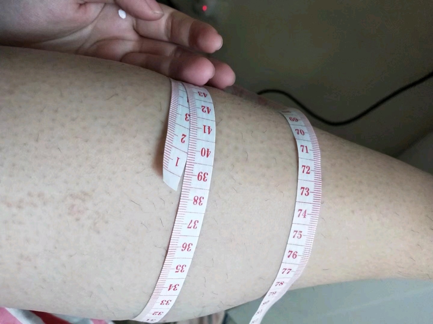 肉毒素瘦肩肌第2天