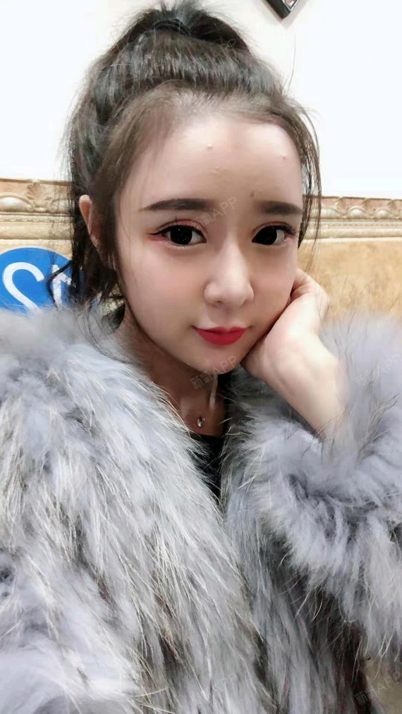 修复的假体下巴依然还是那样饱满,轮廓感合适,就是过_圈子-新氧美容