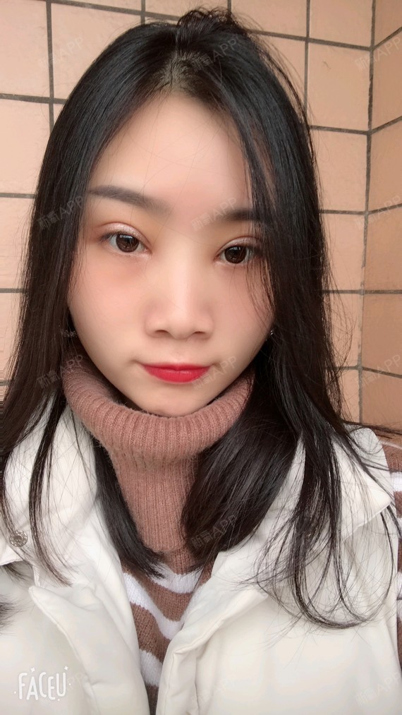 睑缘切开双眼皮术后第30天