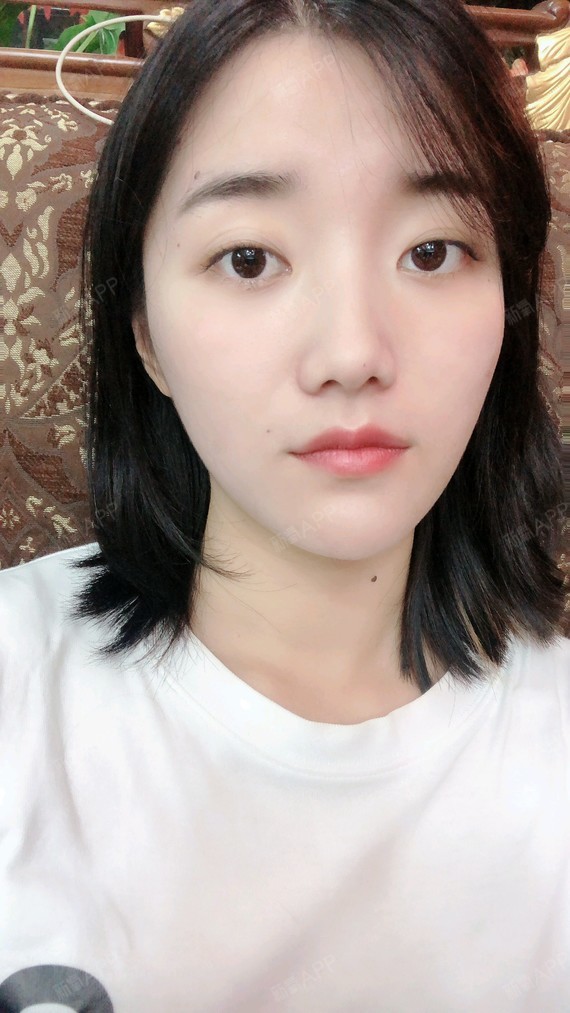 激光祛斑好不好_效果图_仙豆儿激光祛斑术后