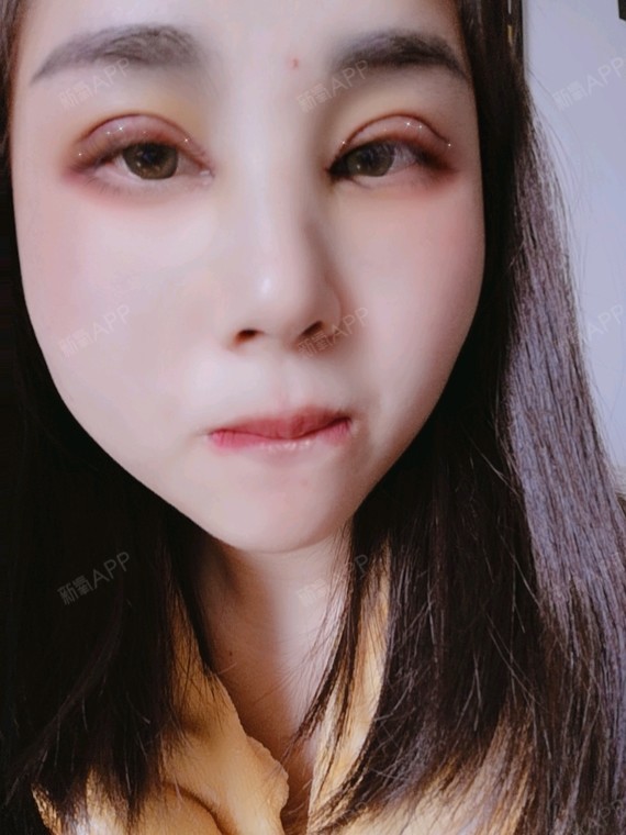 氧气zf40d切开双眼皮第6天美丽日记