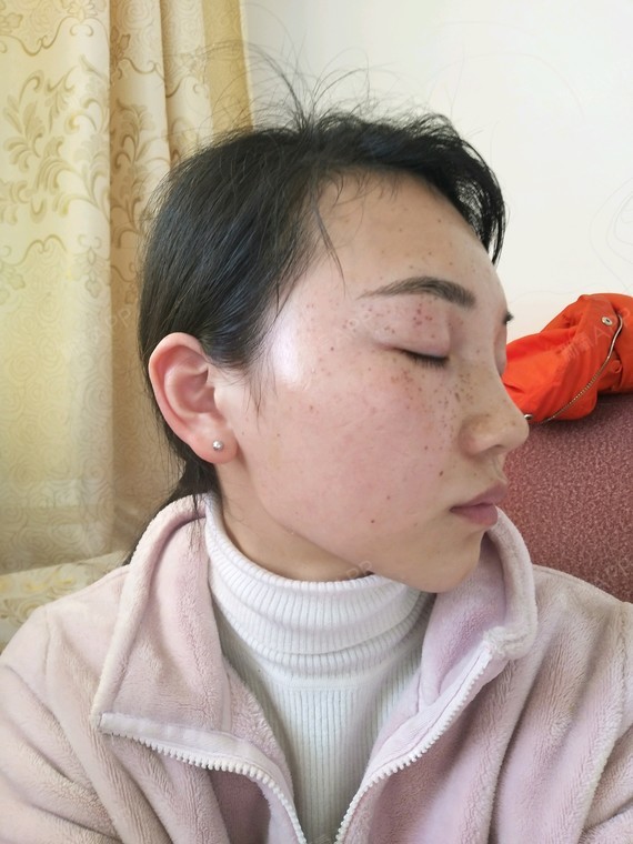 氧气xwinj皮秒激光第5天美丽日记