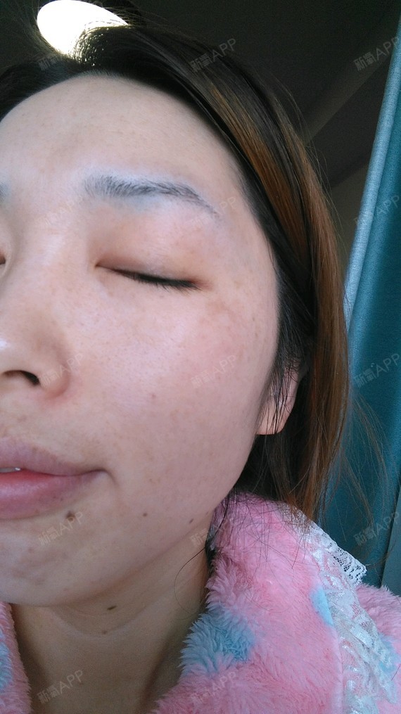 氧气yj9au皮秒激光第27天美丽日记