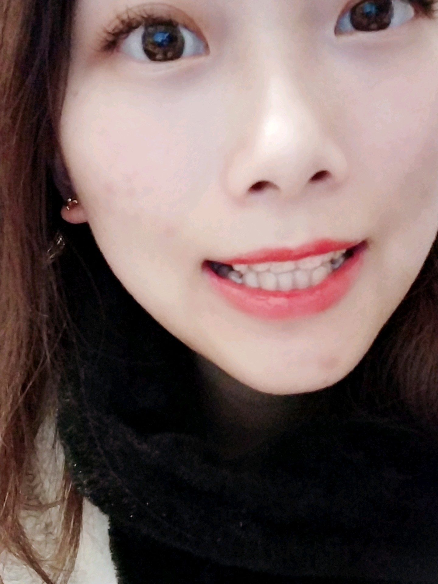 术后第5天