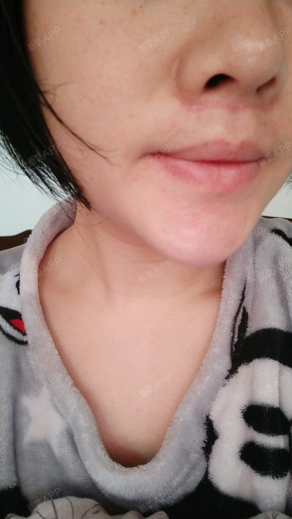 鼻翼两边增生了,三月份开始因为没忌口,偶尔吃微辣,疤痕增生心好累,不