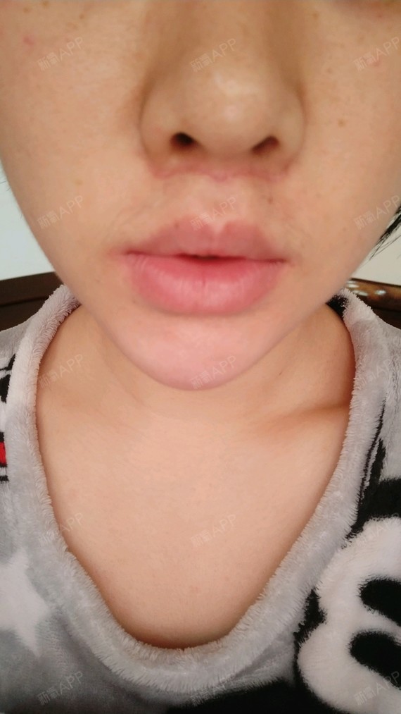 鼻翼两边增生了,三月份开始因为没忌口,偶尔吃微辣,疤痕增生心好累,不