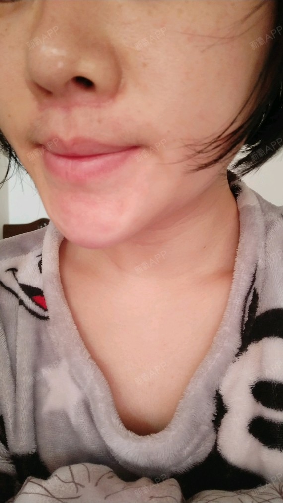 鼻翼两边增生了,三月份开始因为没忌口,偶尔吃微辣,疤痕增生心好累,不