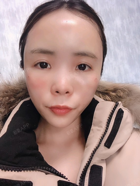 自体脂肪全脸填充好不好_效果图_氧气acca自体脂肪全脸填充术后第1天