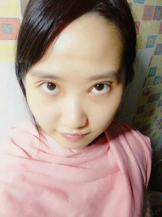 广西南宁眼部多项好不好_效果图_小萱紫眼部多项术后第12天_新氧美容