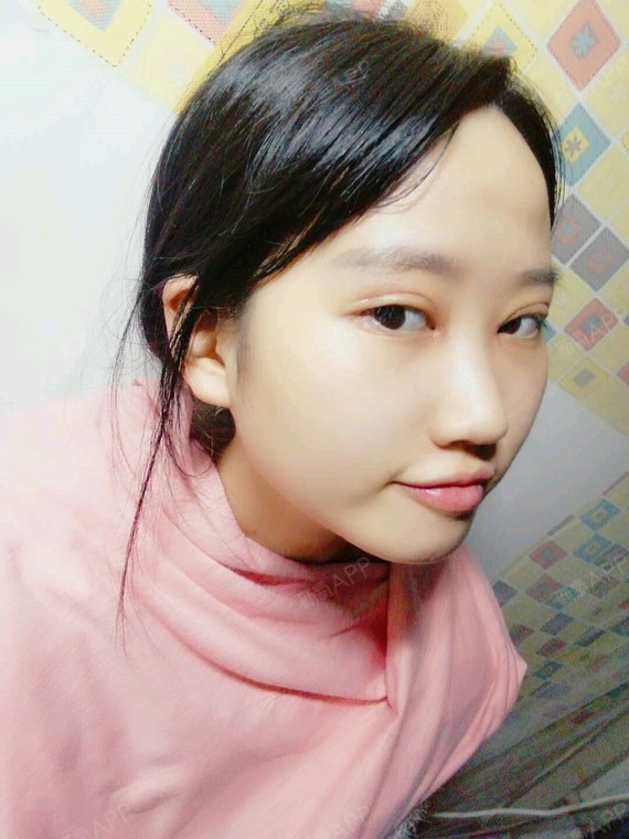 广西南宁眼部多项好不好_效果图_小萱紫眼部多项术后第12天_新氧美容