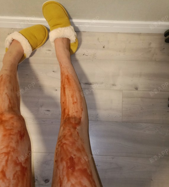 今天是打了肉毒素的第19天了