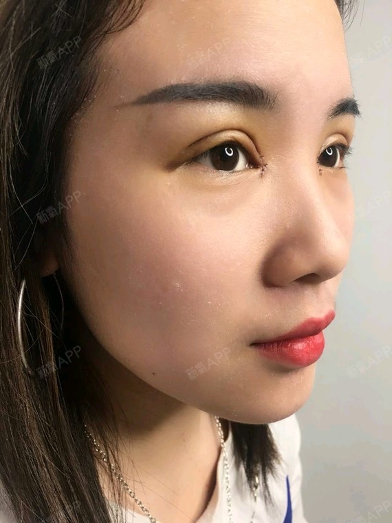 开内眼角第4天美丽日记