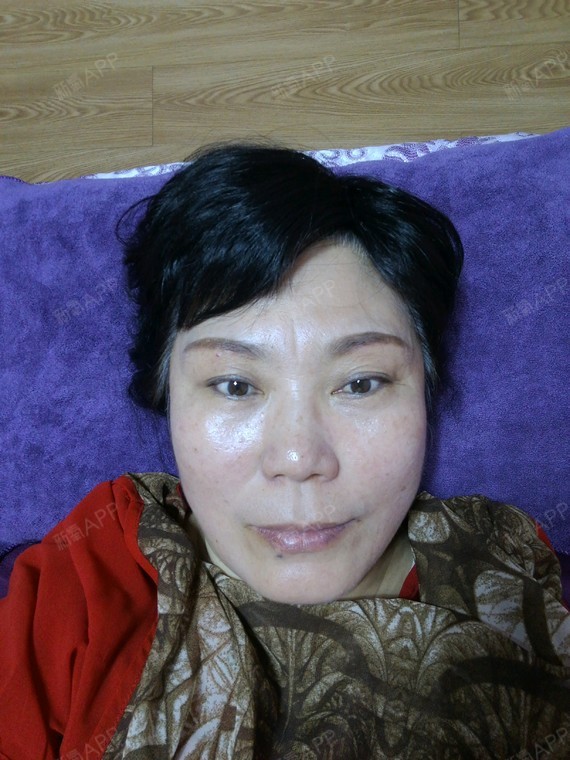 4日拆线,今天是手术第七天,恢复的可以,还有轻微的_圈子-新氧美容整形