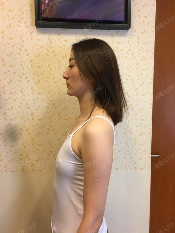 身边的闺蜜和我一样都是产后下垂,她们比我严重很多.因为我本身就小.