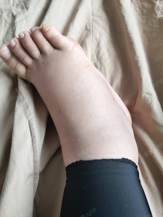 吸脂瘦大腿好不好_效果图_氧气z9rbf吸脂瘦大腿术后第7天_新氧美容