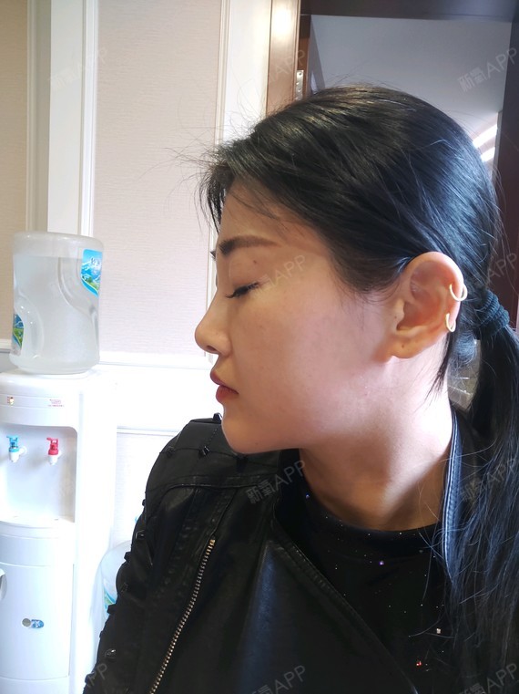 在新氧app推荐的白领安琪儿医美整形做的鼻部多项,一_圈子-新氧美容