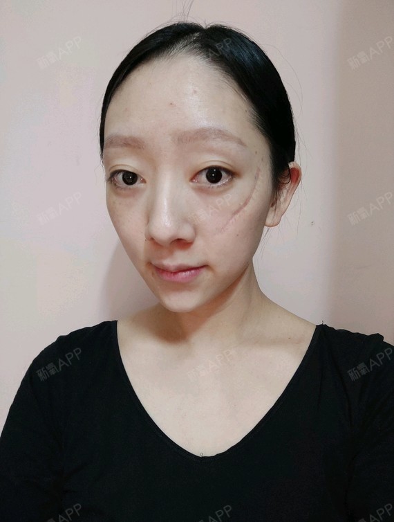 哈喽,新氧的宝宝们,我终于可以把我脸上可恶的疤痕祛_圈子-新氧美容
