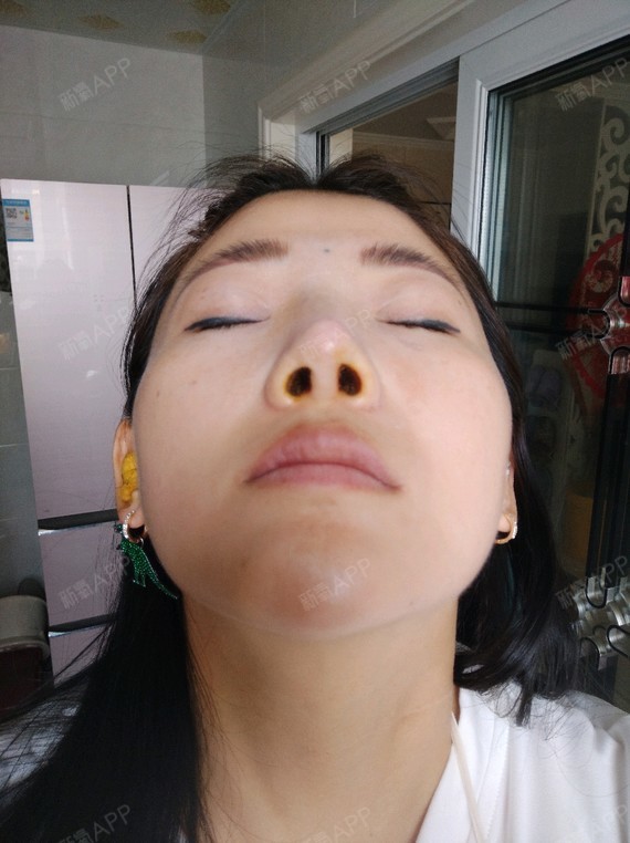 今天是鼻综合第6天,吊水4天,然后吃的消炎药,恢复_圈子-新氧美容整形