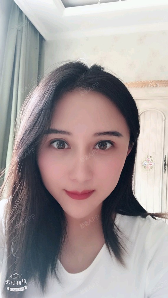 【双眼皮修复术后20天】