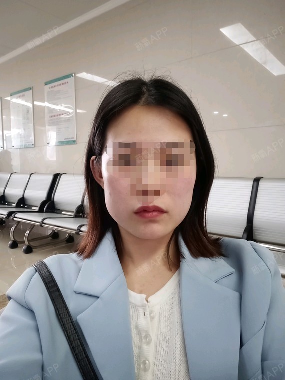 今天上午刚打完拍的,还很肿,咬肌部位鼓起来了.