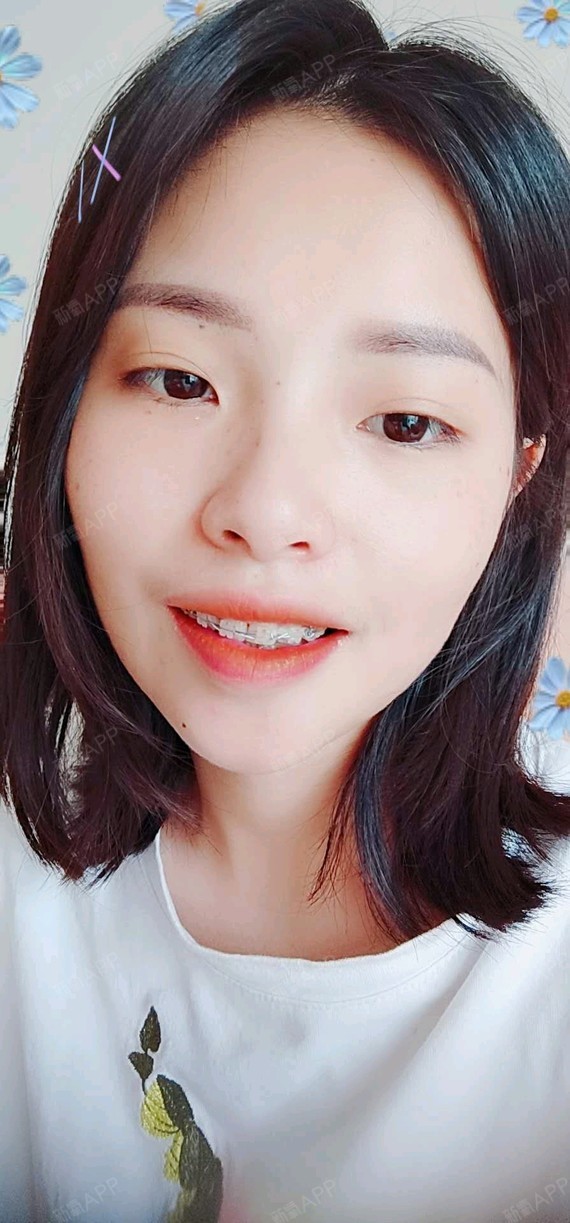 牙齿矫正