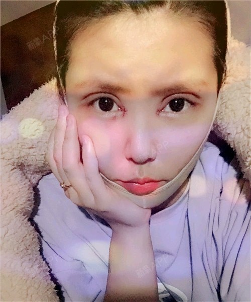 今天是切开双眼皮术后第四天,已经过了严重肿胀期,基_圈子-新氧美容