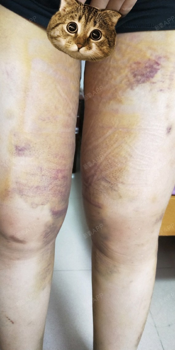 awm123吸脂瘦大腿第6天美丽日记