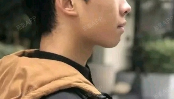 【柏乐口腔牙齿矫正】一年半这样了.侧面好很多.等着拆牙套.