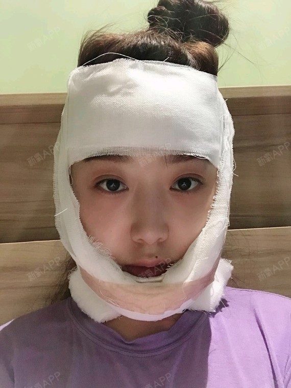 下巴做了磨骨再垫的假体包扎时间就长点,五花大绑的包_圈子-新氧美容