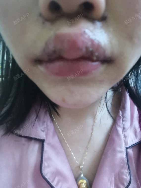 这m唇不知道是肿的原因还是什么,老感觉怪怪的,,感_圈子-新氧美容整形