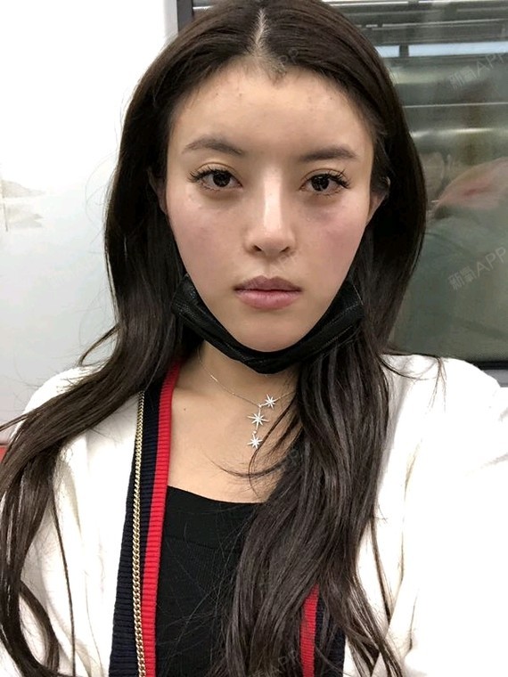 项目:玻尿酸全脸填充