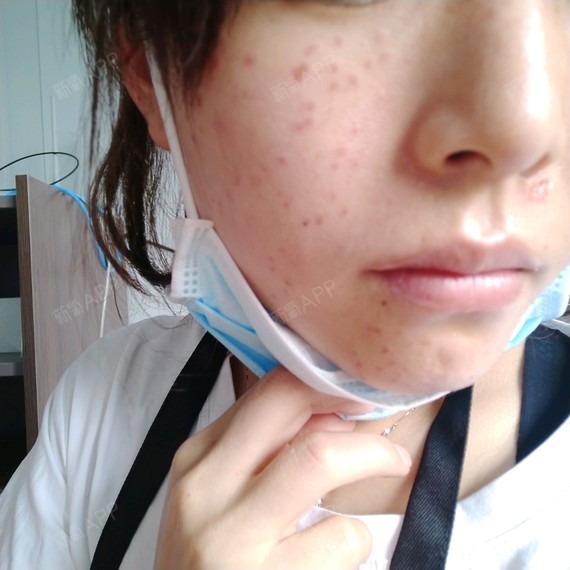 皮秒第一天恢复期