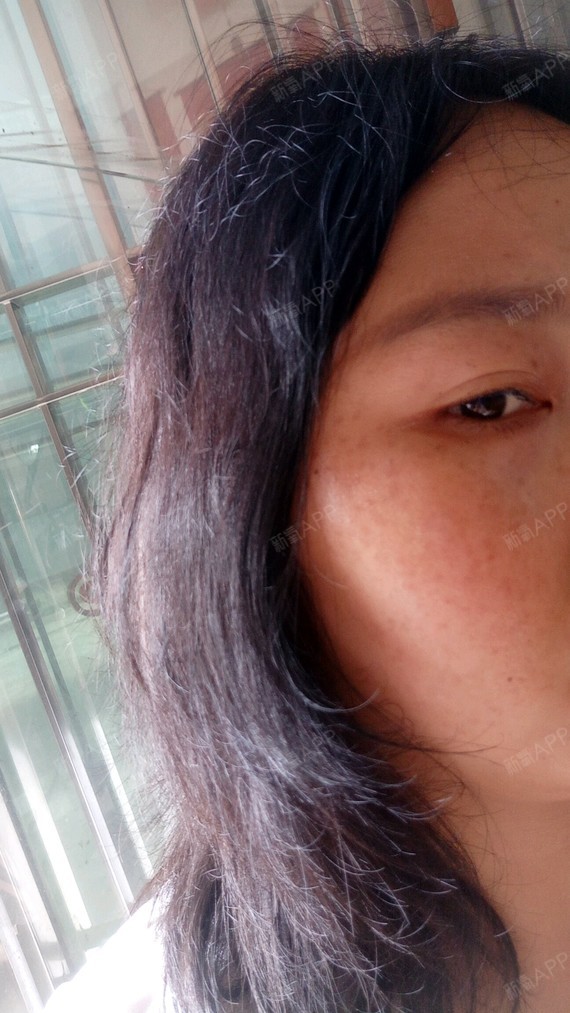 现在做皮秒快两个月了,脸搞的还黑还多斑,都后悔死了_圈子-新氧美容