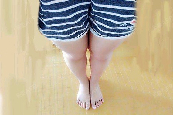 注射瘦小腿好不好_效果图_绿禾苗注射瘦小腿